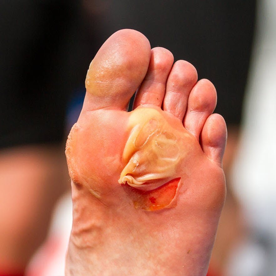 How to Stop Blisters from Shoes: Your Ultimate Guide