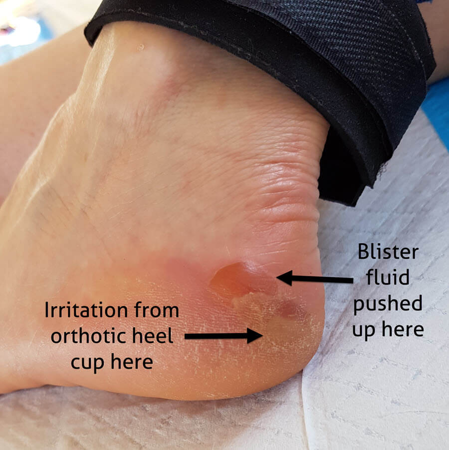 Blisters on Heels from Shoes: Causes, Prevention, and Solutions