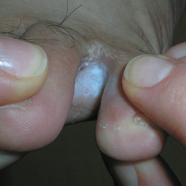 itchy-blisters-on-foot-tinea-pedis-symptoms-causes-treatment