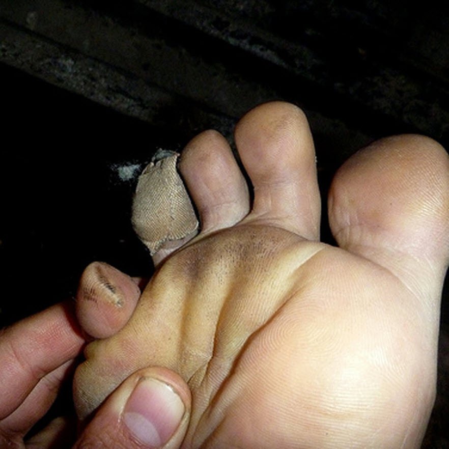 Blister on sale under toe